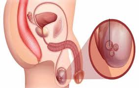 "Medical illustration showing the testicles and highlighting a tumor associated with testicular carcinoma