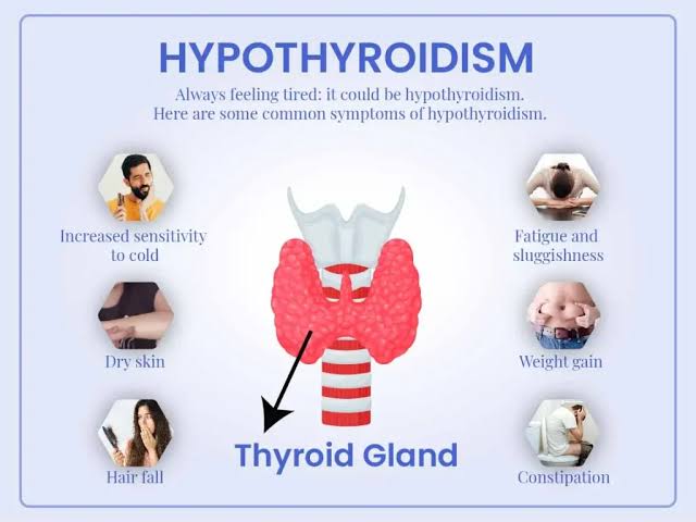 Overview of hypothyroidism, its causes, symptoms, diagnosis, and treatment.