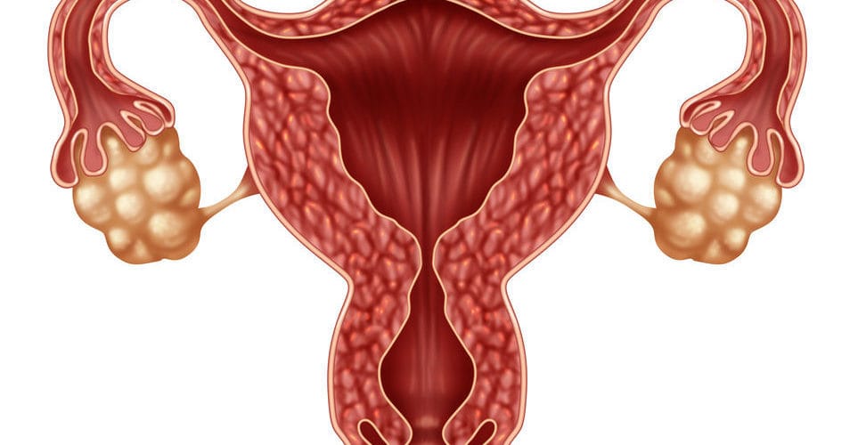 Infographic explaining Polycystic Ovarian Syndrome (PCOS) with key symptoms like irregular periods, acne, and weight gain.